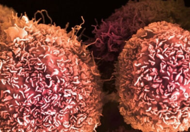 Un fármaco experimental marcó un avance histórico contra el cáncer de páncreas