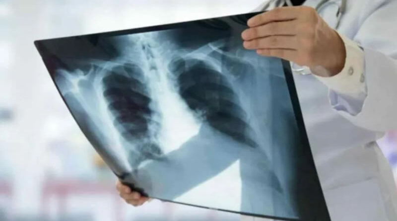 Los casos de tuberculosis aumentaron en Entre Ríos casi un 39% en lo que va de 2026